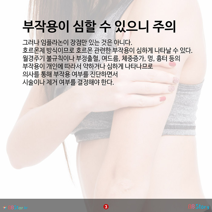 비비스토리, BBStory, 성공률 99.95%로 가장 완벽한 피임방법 임플라논 부작용이 심할 수 있으니 주의